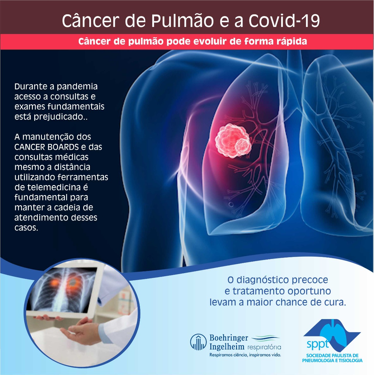 Câncer de Pulmão e a Covid-19